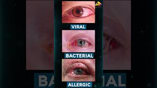 लाल आँख  How to treat Conjunctivitis or Pink Eye 3D Animation by Armature Studios [upl. by Rayburn]