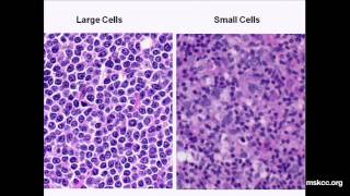 What You Need to Know about NonHodgkins Lymphoma Presentation [upl. by Notecnirp]