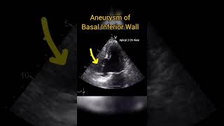 Aneurysm of Basal Inferior Wall echocardiography anatomy heart [upl. by Vinn729]