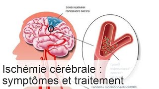 Ischémie cérébrale  symptômes et traitement diagnostic de la maladie [upl. by Nitsirt]