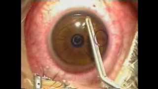 Lasik Laser Eye Surgery Procedure  Live Surgery [upl. by Bertold]