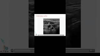 Identifying Ulcerated Plaques foryou riskanalysis vascularultrasound [upl. by Eat]