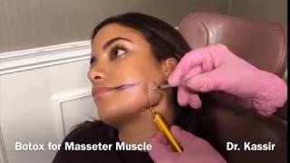 Botox for Masseter Muscle [upl. by Longan974]