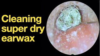 Cleaning super dry earwax ear wax removal  ear cleaning  ASMR  relaxation  relax [upl. by Yur479]