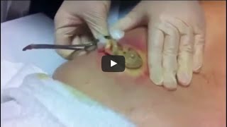 Biggest Pimple Pop Ever Caught On Camera Guiness World Record [upl. by Cleodal58]