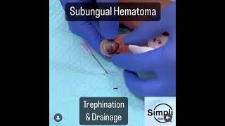 Subungual Hematoma Trephination [upl. by Aekahs]