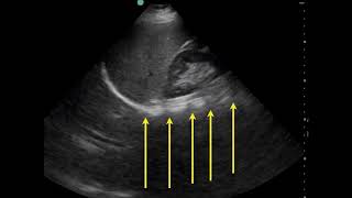 Pleural Effusion Ultrasound [upl. by Drawde]