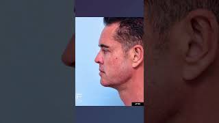 Jaw Dropping Chin and Jawline Filler Before and Afters [upl. by Suzi]