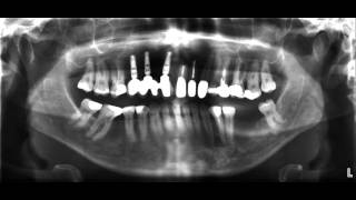 für Zahnärzte das OPTG Röntgen [upl. by Esiuole]