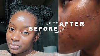 My Hormonal Acne amp Dark Spots Came Back 😭  Starting Accutane  Acne Update 1 [upl. by Ponzo]