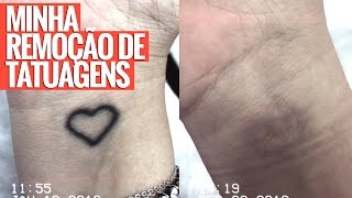 TUDO SOBRE MINHA REMOÇÃO DE TATUAGEM [upl. by Sert724]