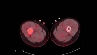 MSK Tumor C9 LCH PET CT [upl. by Yecnay]