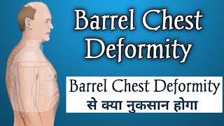 Barrel Chest  Chest Deformity Simplified  Barrel Chest Breathing [upl. by Colas]