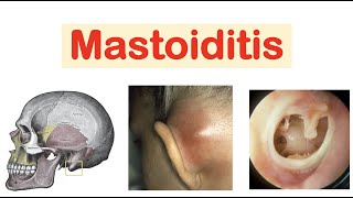 Mastoiditis amp Acute Otitis Media  Causes Pathophysiology Symptoms Diagnosis Treatment [upl. by Eninaej]