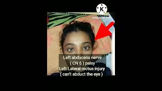 Left abducens nerve  CN 6  palsy [upl. by Ardine]