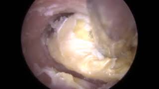 FUNGAL Ear Wax Removal Otomycosis in Otitis Externa Ear Canal  323 [upl. by Weinstock]