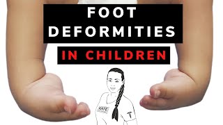 Foot deformities in children amp physiotherapy [upl. by Ynoyrb]