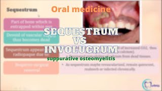 Sequestrum Vs Involucrum  Osteomyelitis  Oral Medicine  Dentophile [upl. by Aissac361]