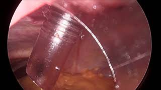 Laparoscopic Sleeve Gastrectomy [upl. by Volnay]