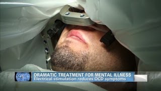 Sanjay Gupta MD Deep brain stimulation helps OCD patient [upl. by Innattirb928]