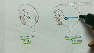 otosclerosis  ENT  etiology  pathophysiology  clinical manifestations  treatment  English [upl. by Nevlin113]