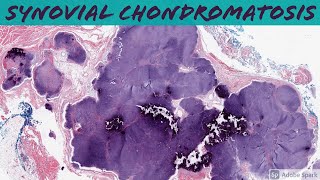 Synovial Chondromatosis 5Minute Pathology Pearls [upl. by Hael]