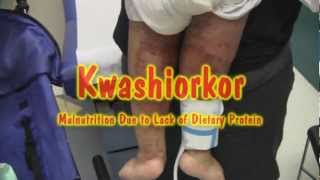 Kwashiorkor [upl. by Anialad]