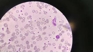 Thrombocytosis under microscopic slide amp haemoglobin concentration detection by RBC size amp shape [upl. by Janessa]