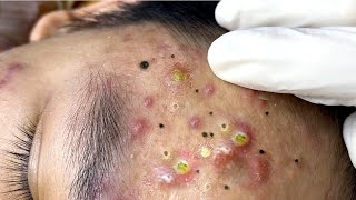 Big Cystic Acne Blackheads Extraction Blackheads amp Milia Whiteheads Removal Pimple Popping  7051 [upl. by Merriam]