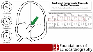 Level 1 Video Lecture Pericardial Effusions and Cardiac Tamponade [upl. by Papert]