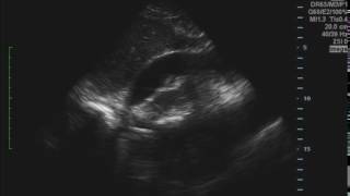 Cardiac Tamponade Ultrasound JETem 2016 [upl. by Annehsat]