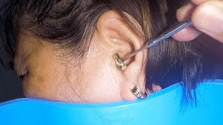 Removing Grandmas 70 Year Old Earwax  Its STUCK [upl. by Dona]