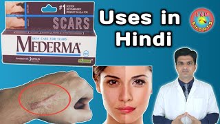 Mederma cream  mederma for acne scars  mederma advanced scar gel review [upl. by Gisele872]