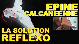 EPINE DU TALON CALCANEENNE DE LENOIR ESSAYEZ LA REFLEXOLOGIE PLANTAIRE LA SOLUTION NATURELLE [upl. by Katharina]