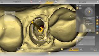 Digital Post and Core  InLab  Dentsply Sirona CADCAM [upl. by Ayeka]