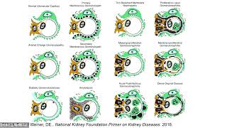 Updates in Glomerular Disease [upl. by Nanette]