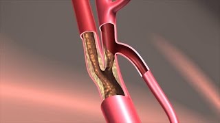 Endarterectomy Treatment [upl. by Regor]