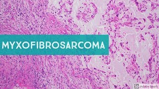 Myxofibrosarcoma 101Explained by a Sarcoma Pathologist [upl. by Ilatfan709]