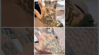 Healing process for laser tattoo removal [upl. by Ennaylil190]