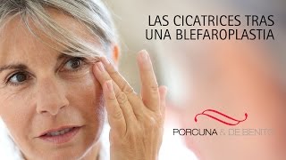 Las cicatrices tras una blefaroplastia [upl. by Vina]