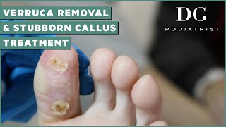 Verruca Mother Removal and Stubborn Callus Treatment  The Foot Scraper DG Podiatrist [upl. by Mcclenaghan]