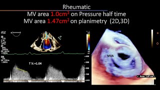 In Mitral Stenosis disparity between various methods to assess MV area [upl. by Garretson]