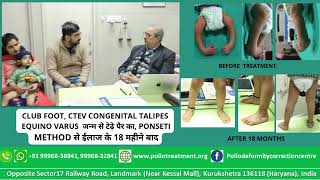 CTEV CONGENITAL TALIPES EQUINO VARUS जन्म से टेढ़े पैर का PONSETI METHOD से ईलाज के 18 महीने बाद [upl. by Kurtzman633]