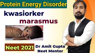 kwashiorkor and marasmus disease in hindi  protein energy malnutrition disorder  neet 2025 biology [upl. by Rossy]