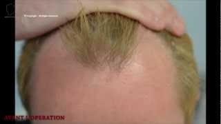 FUE 2207 Ufs MeDiKemos Hair Transplantation FR [upl. by Maloy]