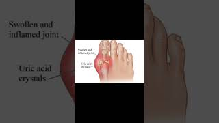 Uric acid crystals in joint health uricacid [upl. by Hildagarde]