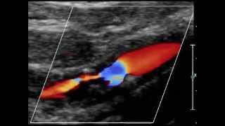 hemodynamic stenosis of the internal carotid artery [upl. by Eniledam994]