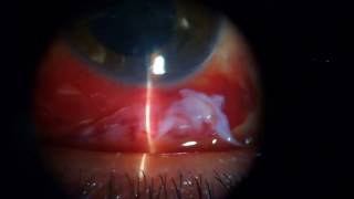 Conjunctival lacerations [upl. by Anastas]