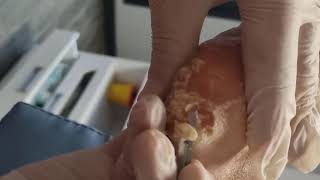 Removing Extremely Hard Foot Callus 🦶 The right way to remove foot callus FULL TREATMENT 10 [upl. by Costin936]