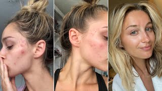 HOW I CLEARED MY ADULT ACNE [upl. by Satterfield]